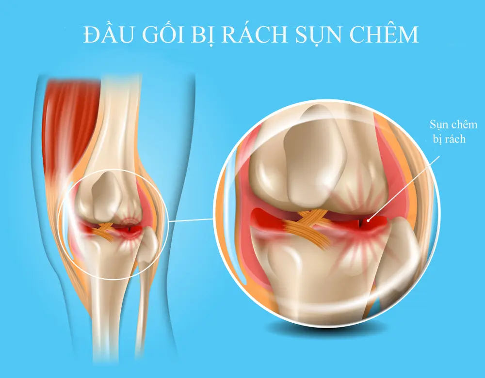 Sụn chêm có thể rách theo nhiều hình thái và vị trí khác nhau